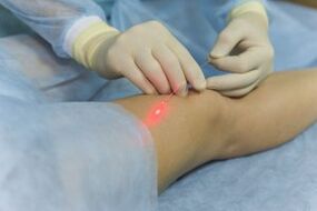 chirurgie des varices dans les jambes