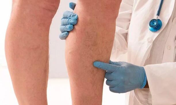 le médecin examine les jambes à la recherche de varices
